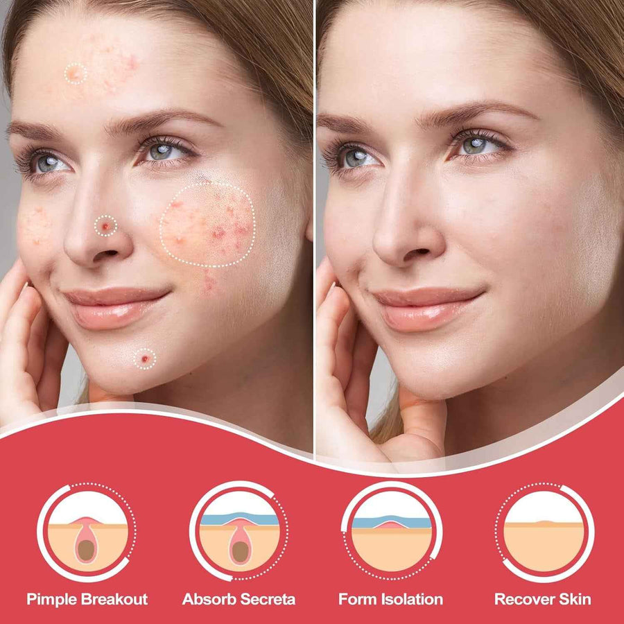 Parches Anti-Granos Hidrocoloide antes y después sobre el rostro.